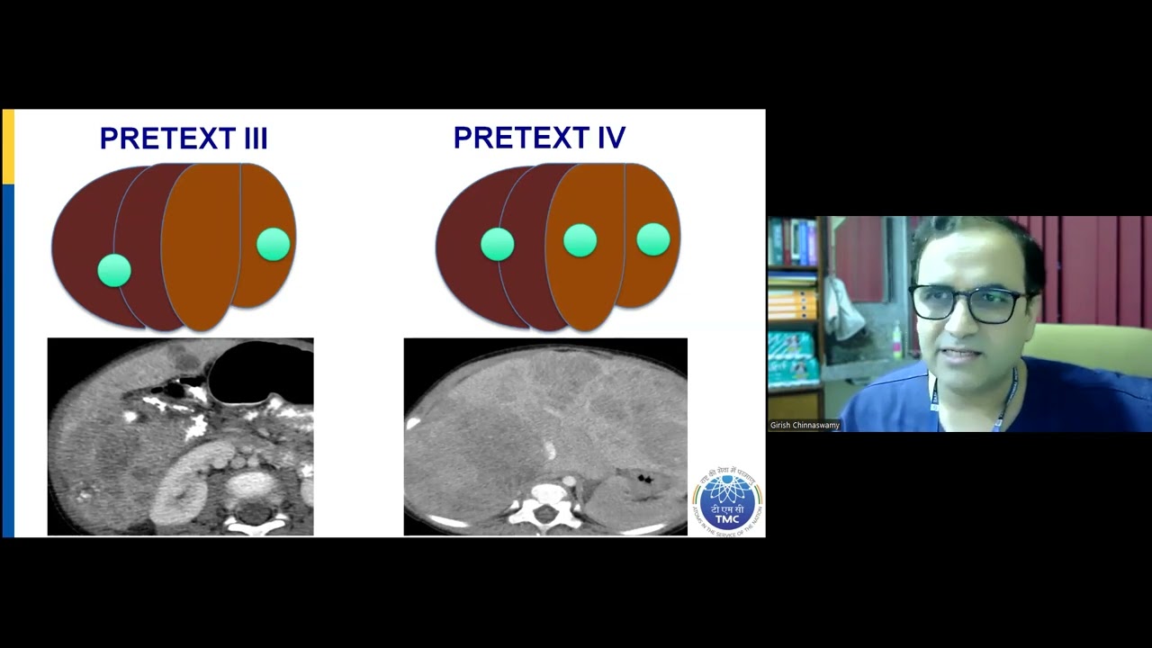Pediatric Liver Tumors: Diagnosis to Multidisciplinary Management