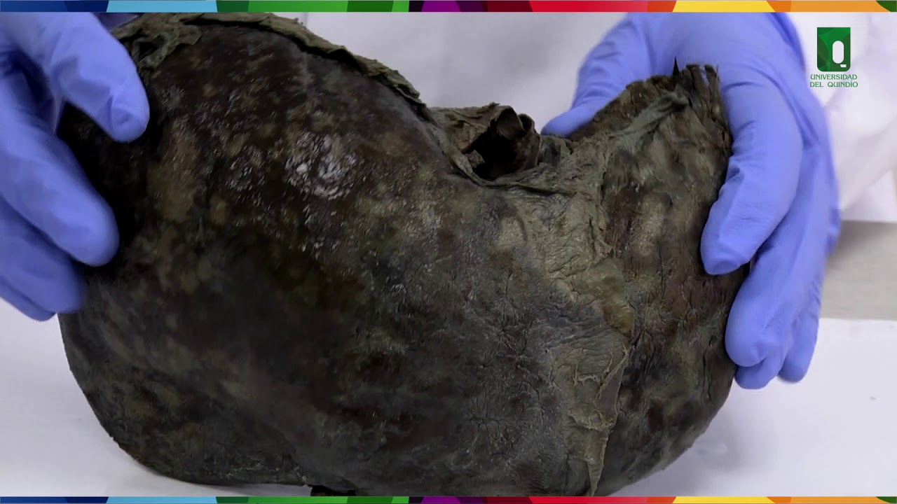 HIGADO II  ANATOMIA ANFITEATRO DR OROZCO