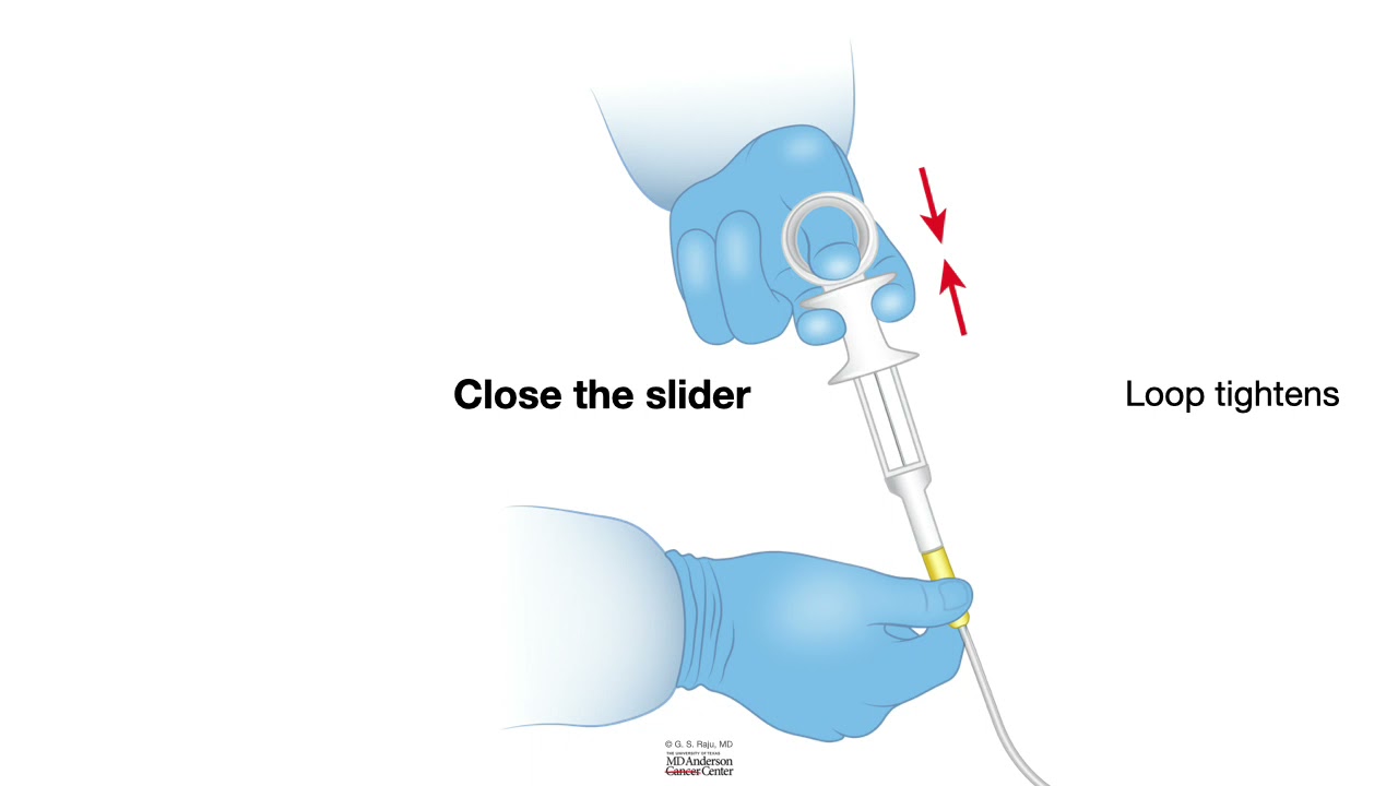 HCC-1472-Lesson11a4-Hemostatic Devices-Loop ligator