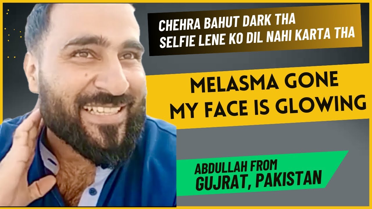 Abdullah’s  from Pakistan: Melasma gone in 4 months, face is glowing. Pehly Selfie nahi le pata tha