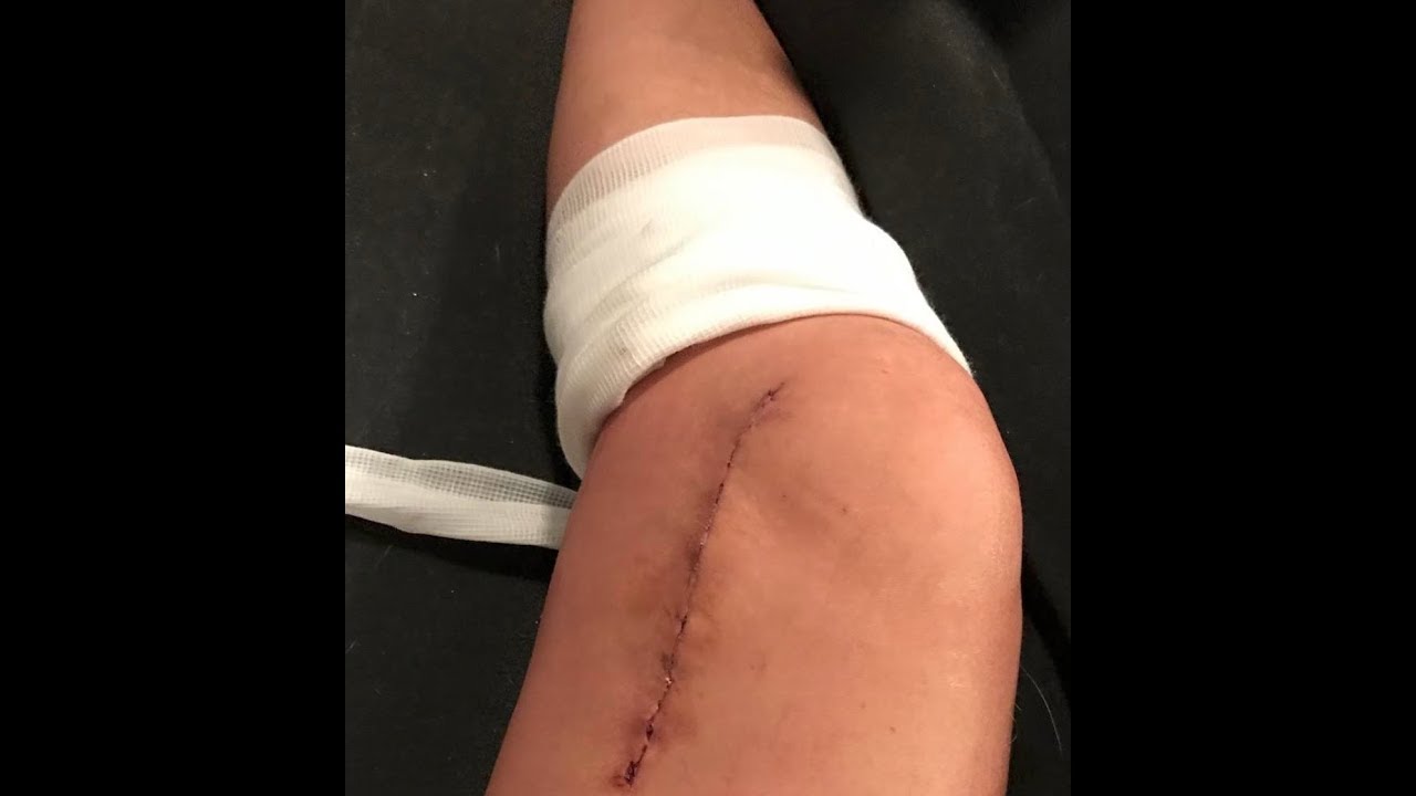 My Giant Cell Tumor Story
