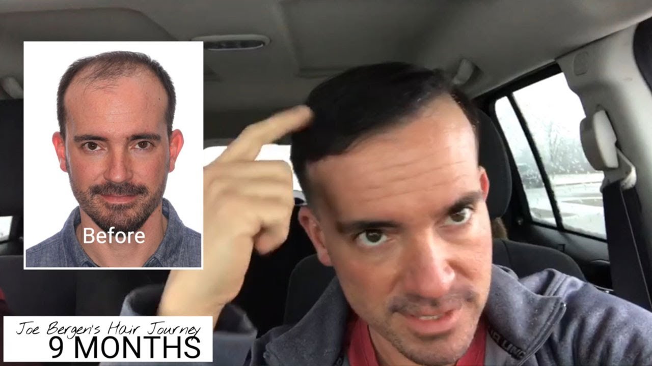 Multi-Unit Hair Grafting™ Hair Transplant Results - Day 1 Through 12 Months