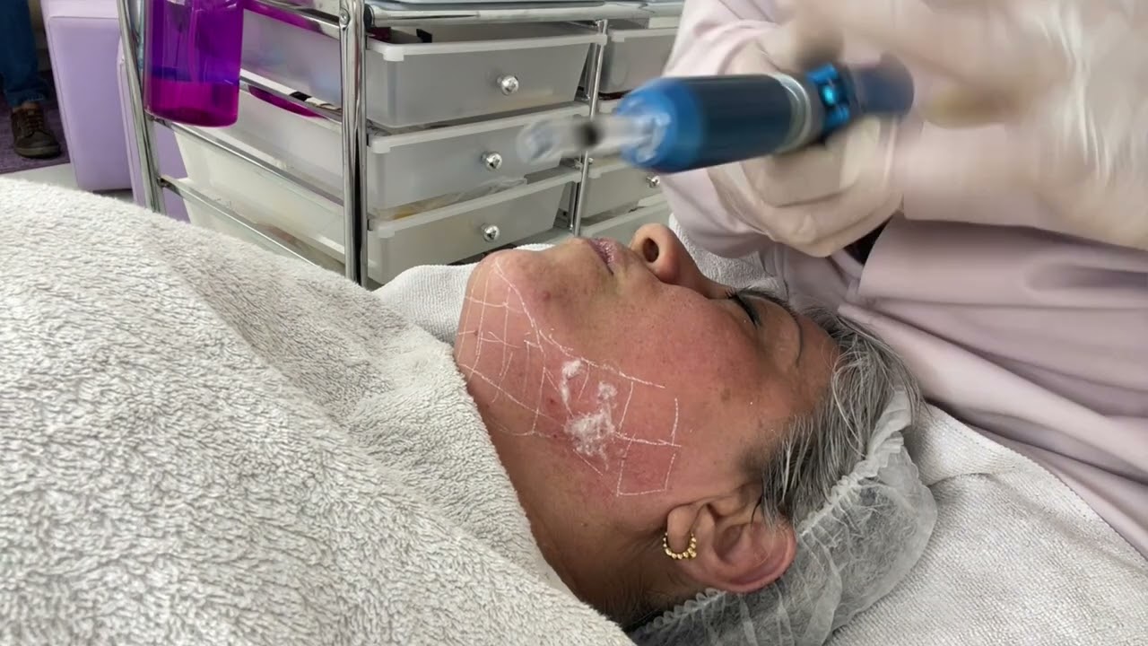 Tratamento de papada flácida com mini Hifu e intradermoterapia