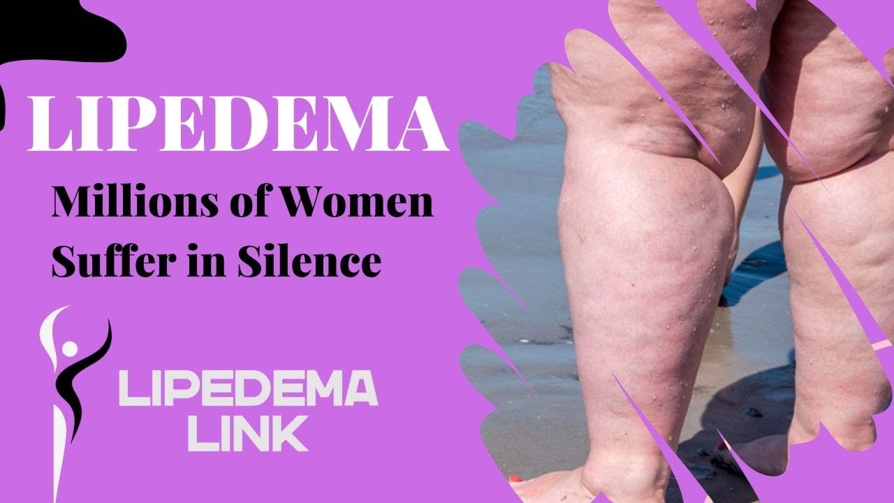 Lipedema: Millions of Women Suffer in Silence
