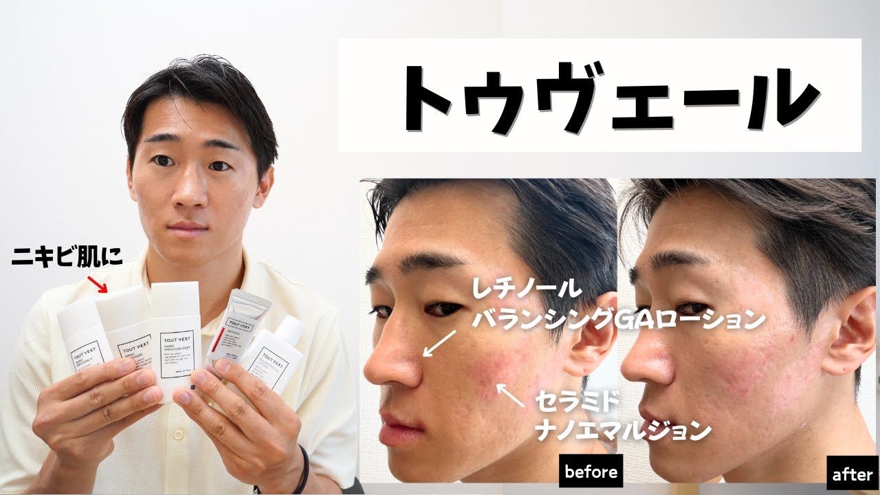 【脂性肌・ニキビ肌】トゥヴェールのスキンケアが完璧すぎる…レチノールからバランシングgaローション、ナノエマルジョンまで徹底比較！