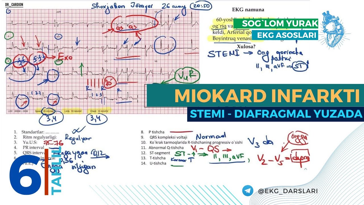 = EKG Tahlili-06 =  Miokard Infarkti =  EKG Namunasi =