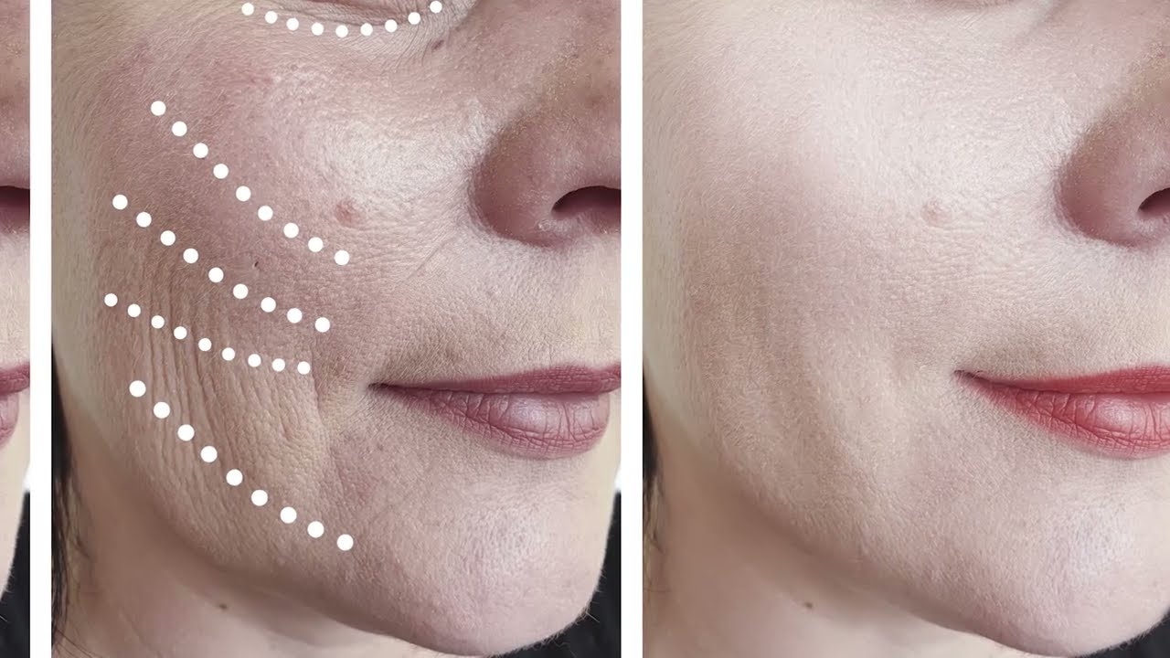 Sculptra Treatment | Juno MediSpa