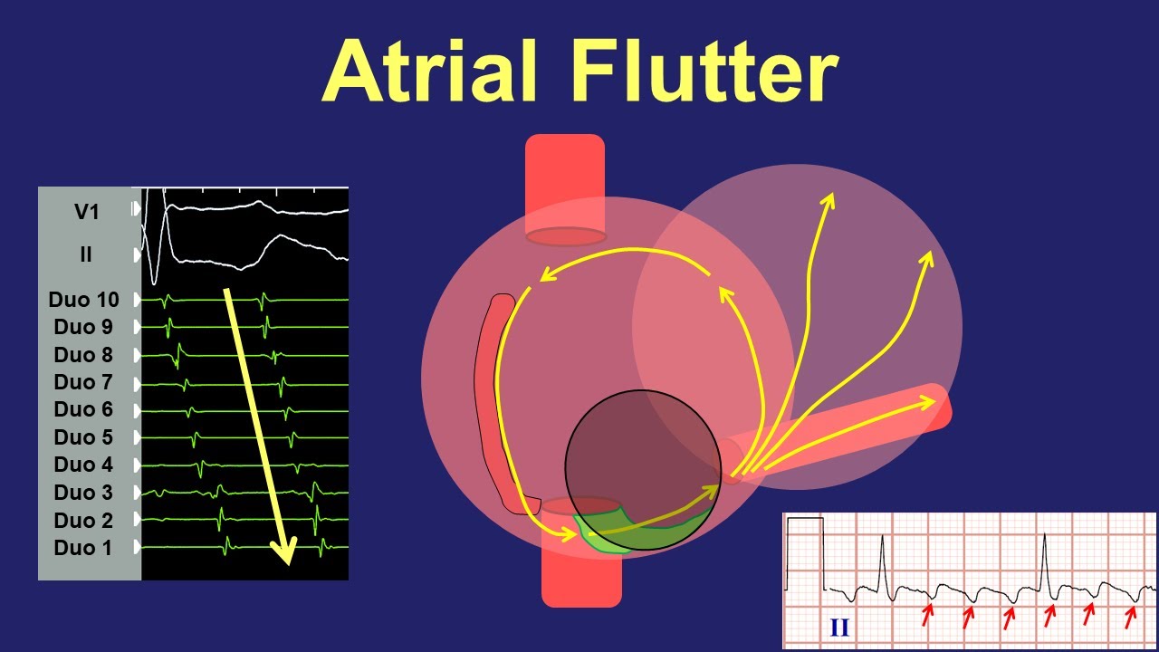 Atrial Flutter - Fundamentals of Diagnosis and Ablation