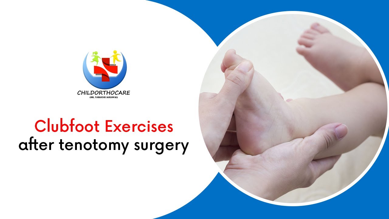 Упражнения для коррекции косолапости после операции тенотомии