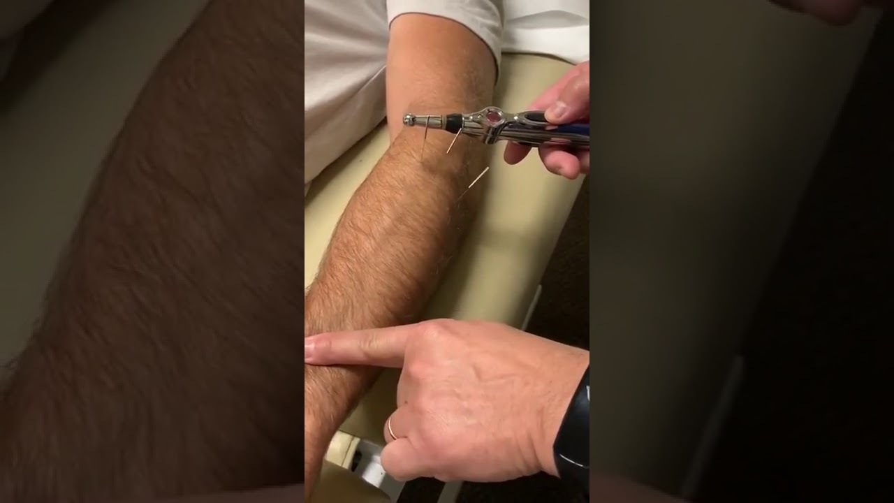 Tennis Elbow Acupuncture with the AcuPen