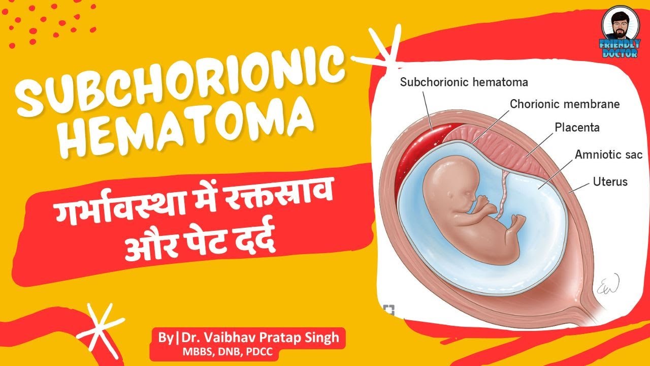 Subchorionic Hematoma During Pregnancy: Risks and Management || गर्भावस्था में रक्तस्राव और पेट दर्द