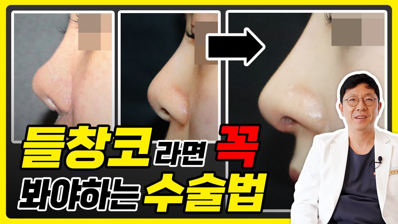 예뻐지는 들창코 수술사례｜코앤영의원 #코끝수술 #광주코성형