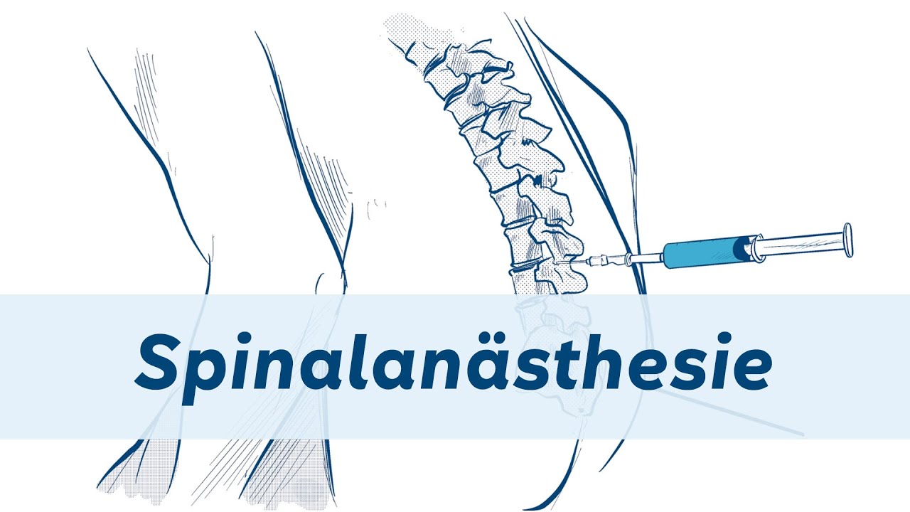 Informationsfilm über die Spinalanästhesie - NÖ LGA