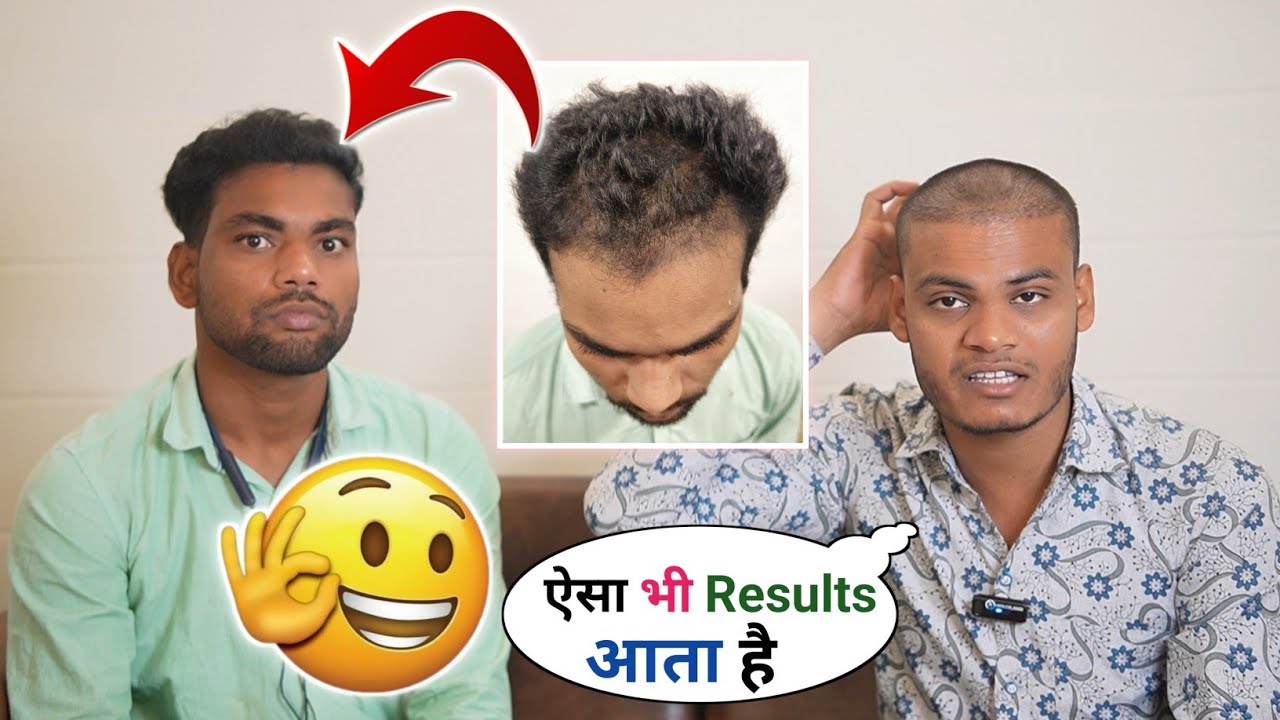 Hair Transplant Results in India | Hair Transplant Before And After | Hair Transplant Best Results