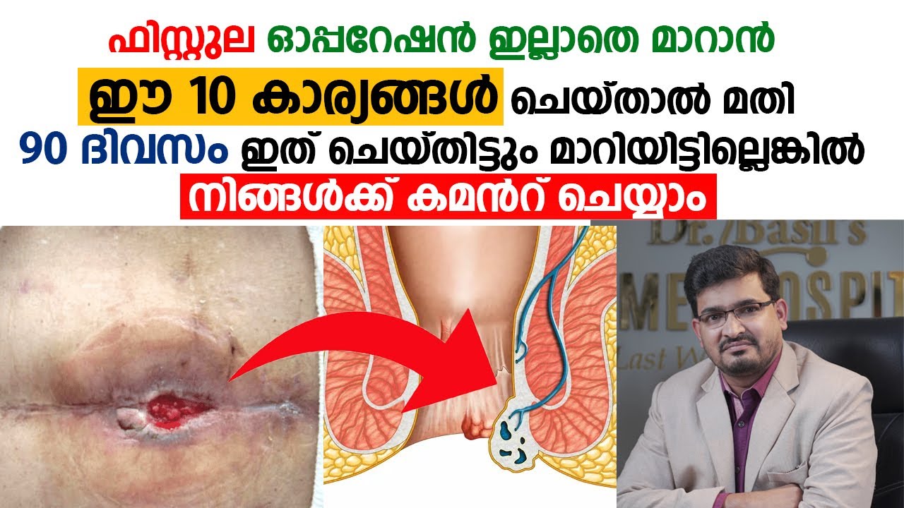 #ഫിസ്റ്റുല ഓപ്പറേഷൻ ഒഴിവാക്കാനുള്ള 10 കാര്യങ്ങൾ #Fistula