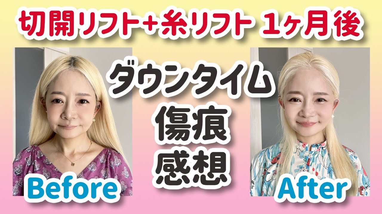 【切開リフト+糸リフト】ダウンタイム・傷痕・ビフォーアフター・フェイスリフト１ヶ月後の感想