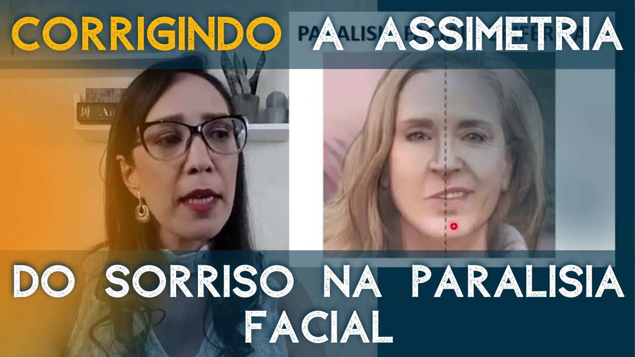 Corrigindo a assimetria do sorriso na paralisia facial