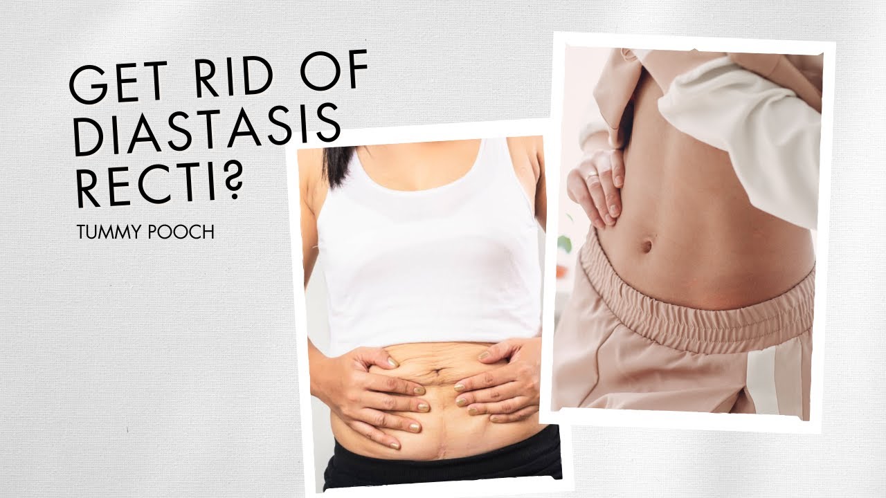 What is Diastasis Recti? | Tummy Muscle Separation After Pregnancy Explained