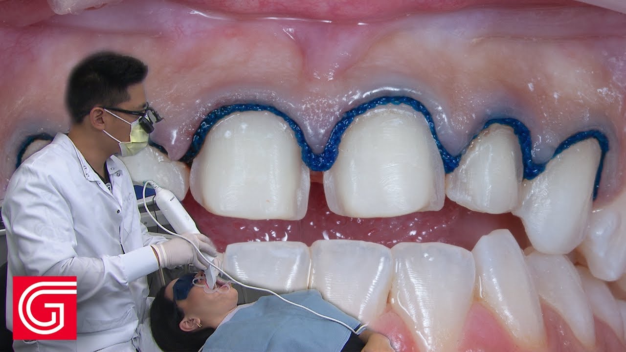 Digital Scanning for ANTERIOR Provisional Teeth #6-#11: 3 of 4