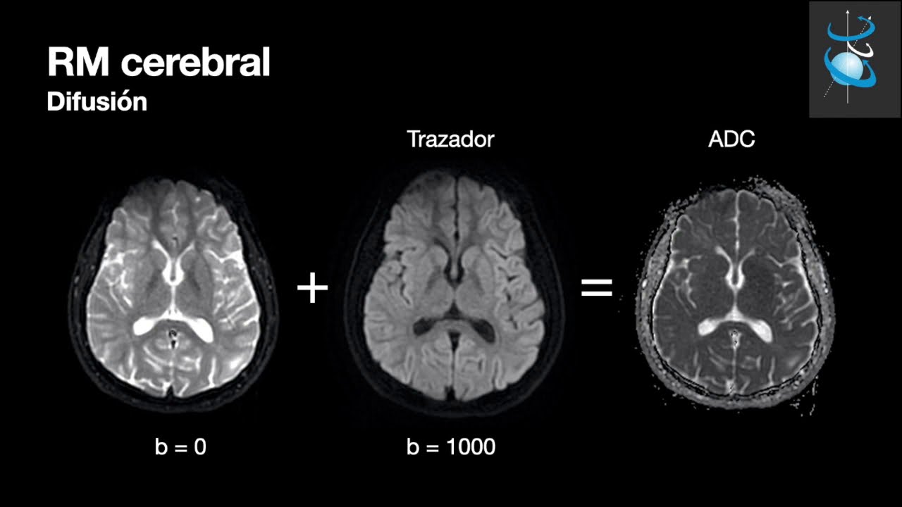 RM Cerebral. Parte 1:  Secuencias básicas.