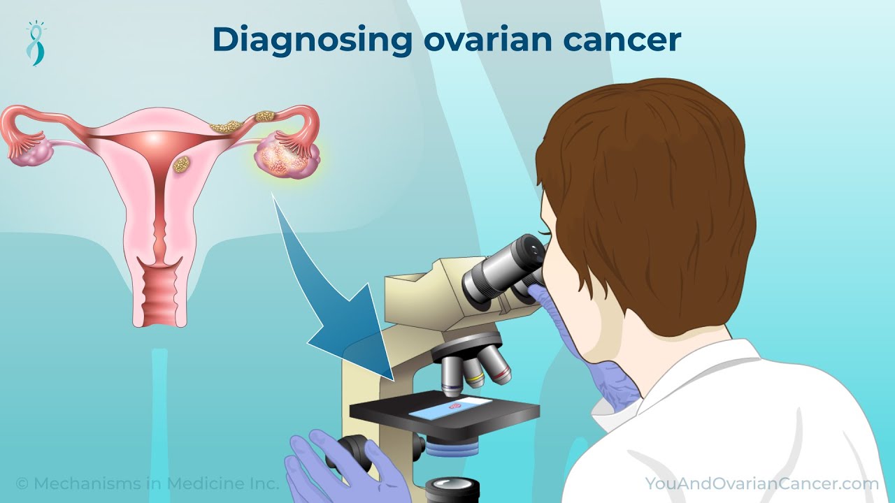 Diagnosing Ovarian Cancer