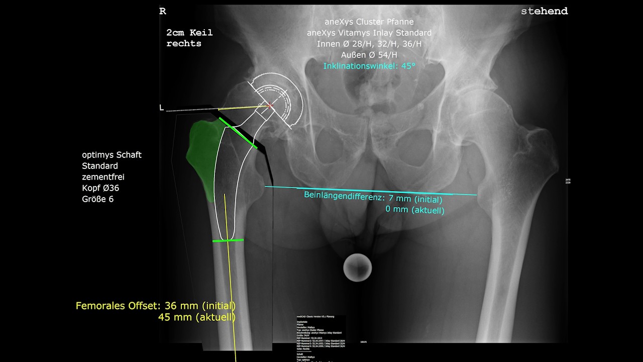 Die Kurzschaftprothese mit Keramik-Gleitpaarung, der Hüftgelenkersatz für junge und aktive Patienten