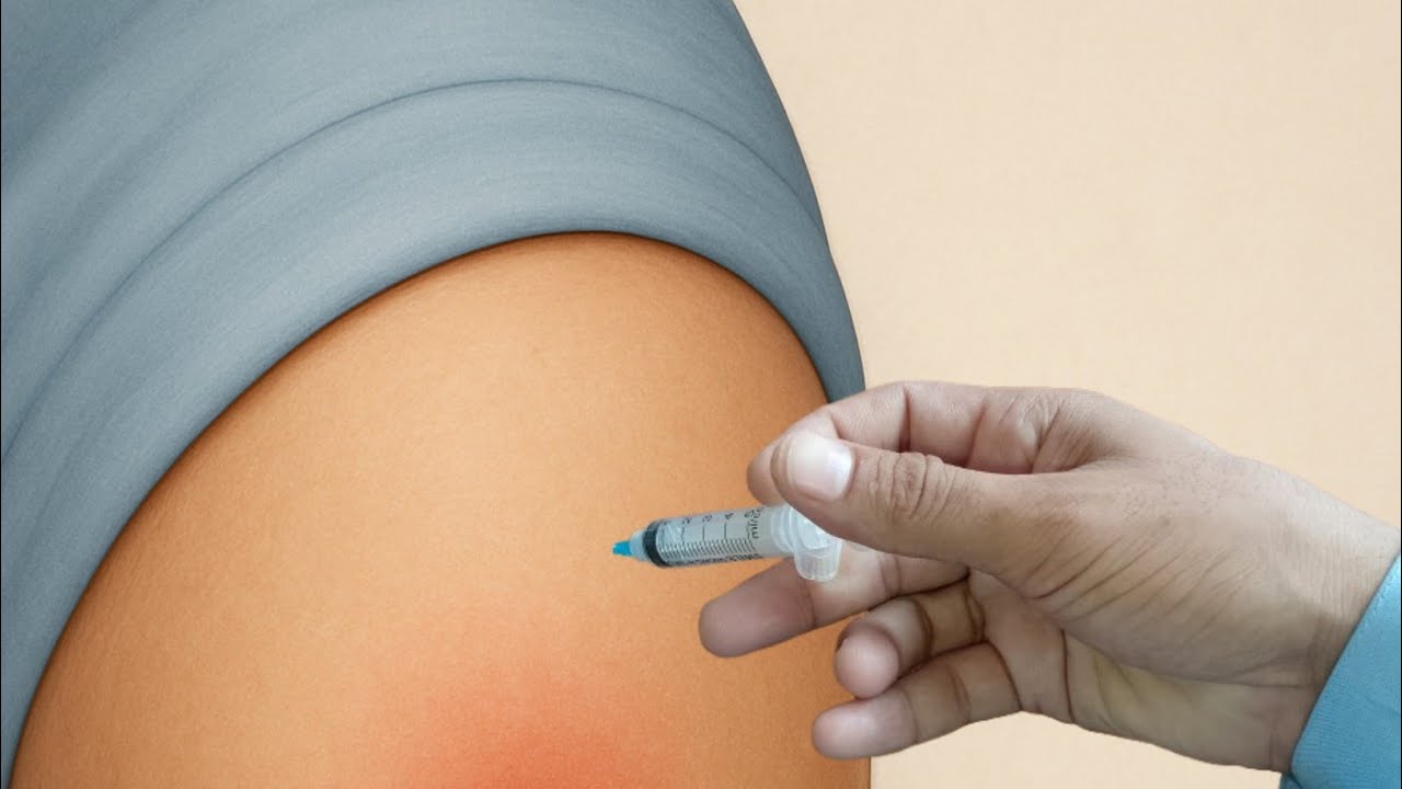 IM Injection Techniques. Best Practices