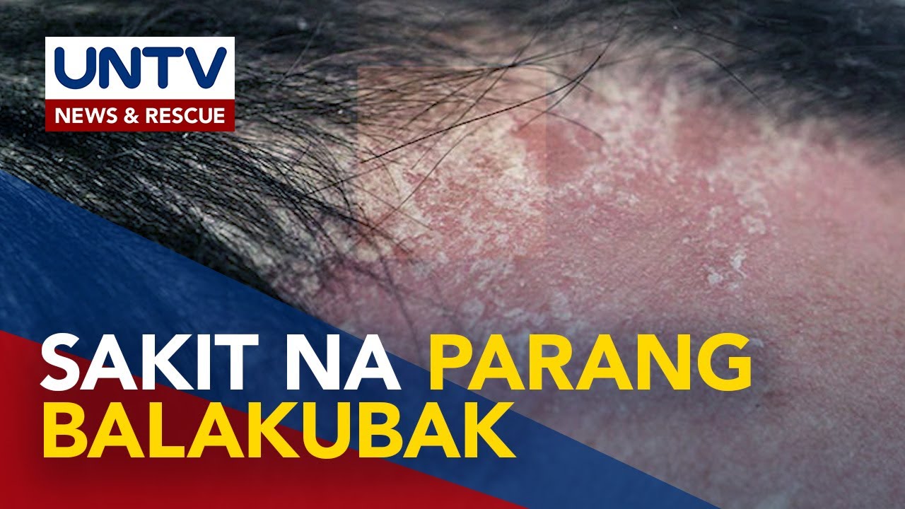 ALAMIN: Makati, masakit at makapal na balat na tila dandruff, sintomas ng seryosong sakit