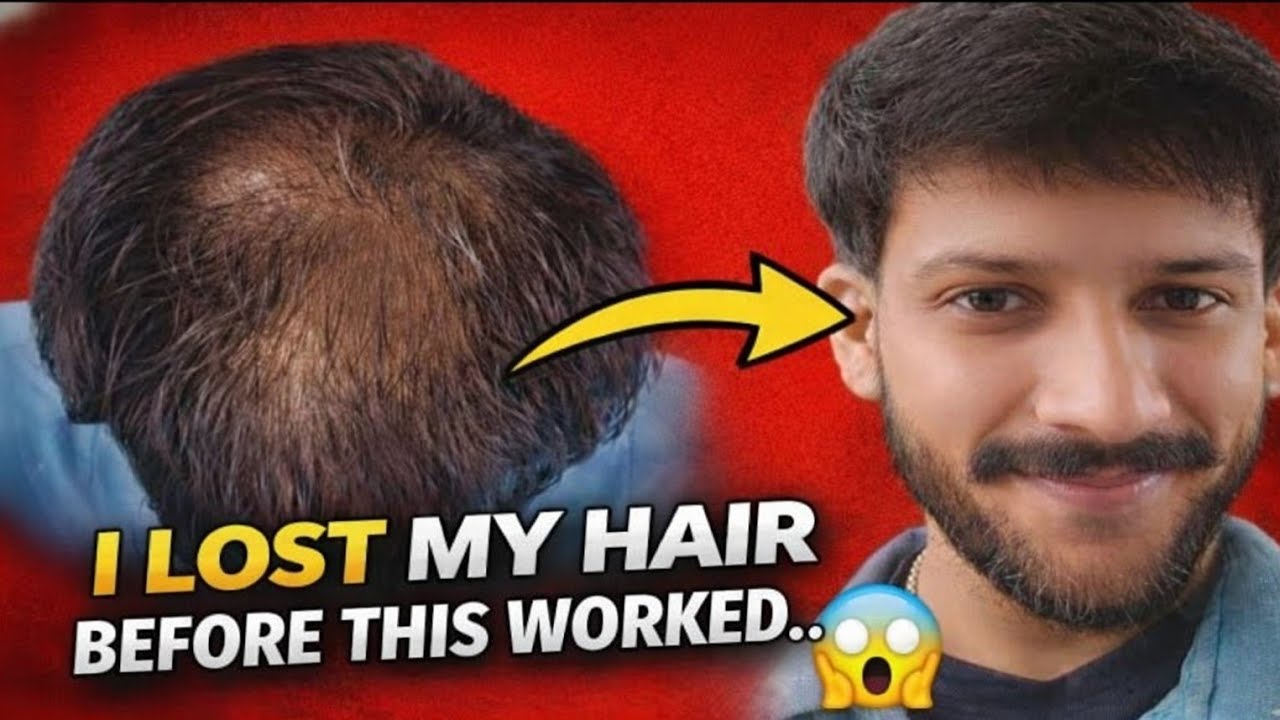 I tried everything for hairloss...This finally worked || Shivankur Sharma 