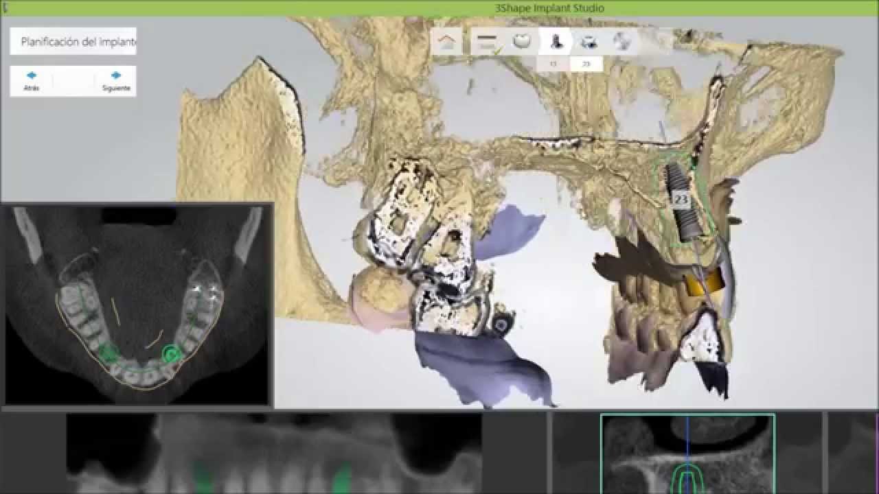 Implantes dentales con protocolo 3D completo