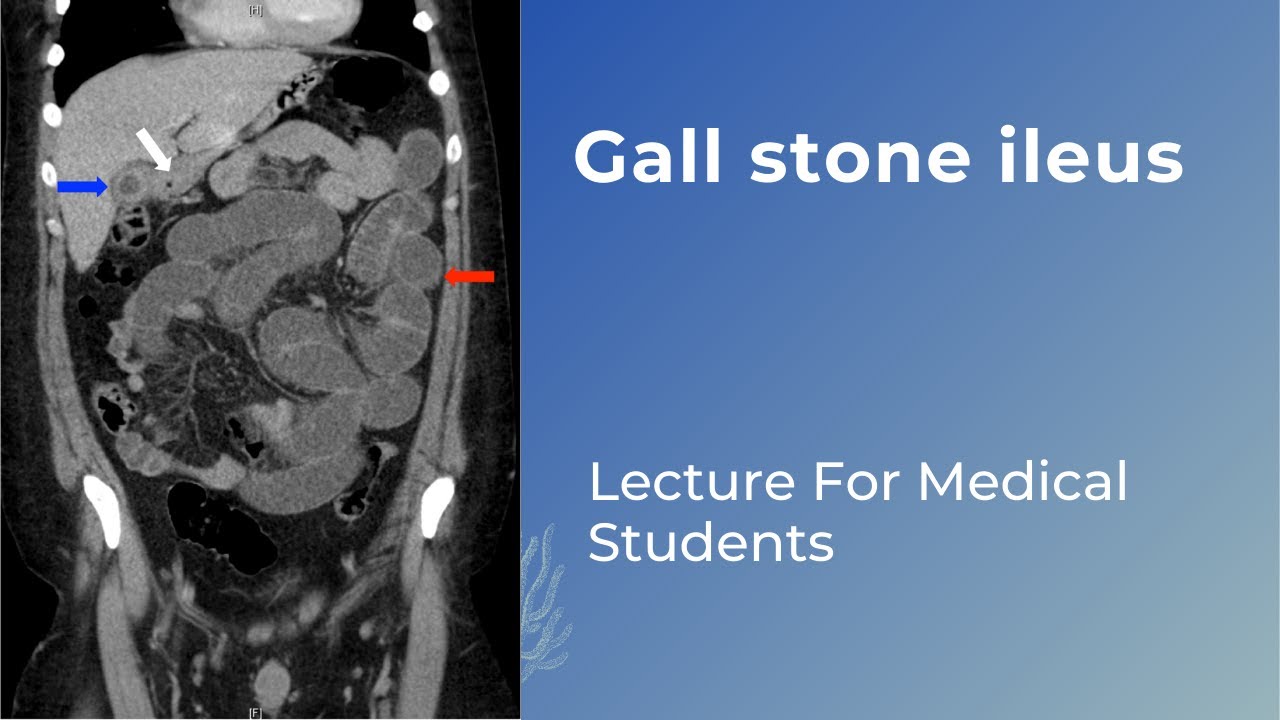 Gall stone ileus  #neetpg #fmge #usmle
