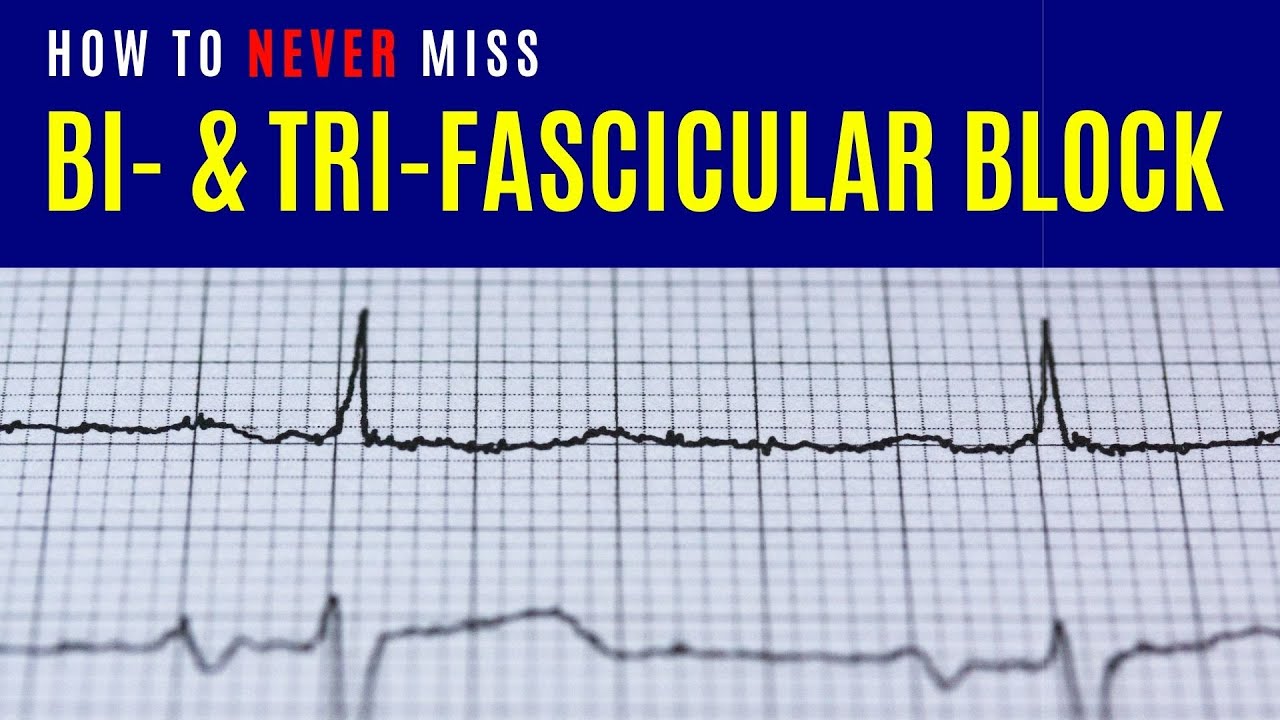 Bifascicular and trifascicular block