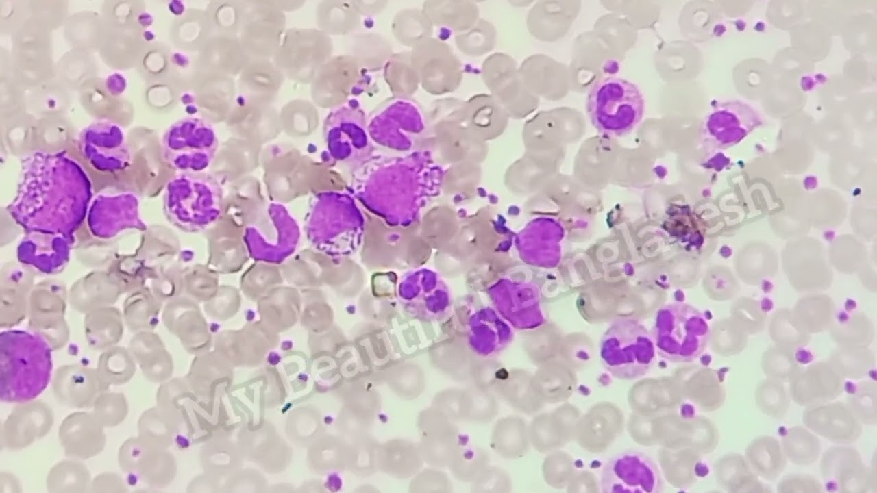 Chronic myeloid leukaemia Chronic phase. Chronic phase Chronic myeloid leukaemia (CML).