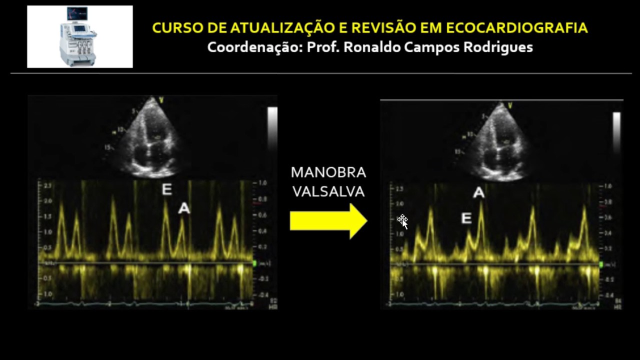 DIRETRIZ ASE/EACI 2016 - ESTUDO DA FUNÇÃO DIASTÓLICA DO VENTRÍCULO ESQUERDO