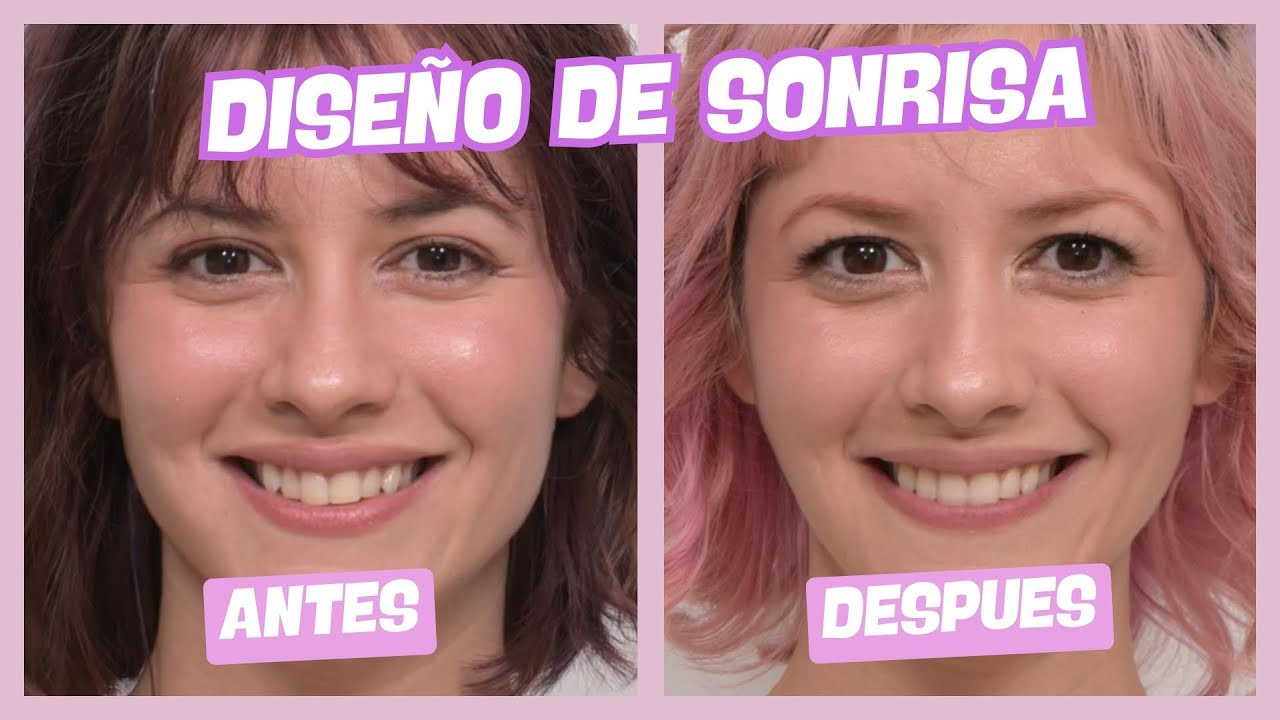 Vlog en Corea | ME HICE EL DISEÑO DE SONRISA Y ME CAMBIO LA CARA? @연세정원치과 Yonsei JW Dental Clinic