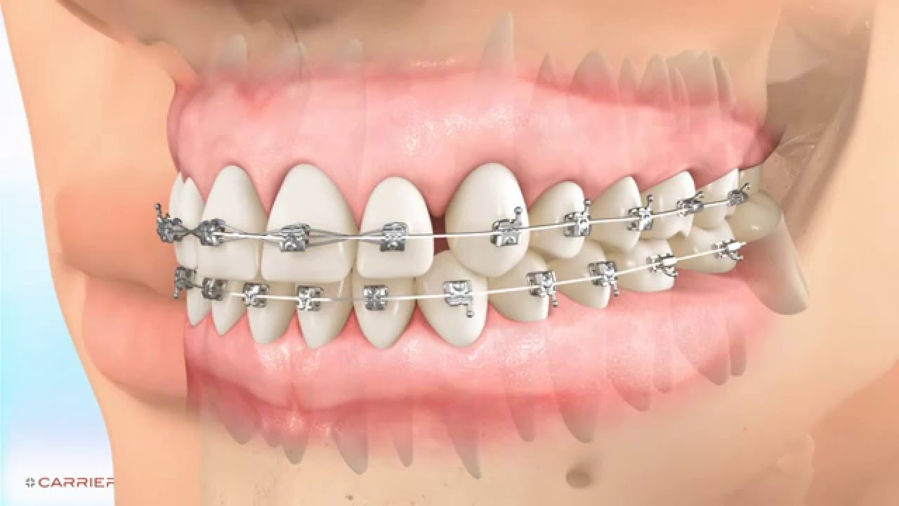 Carriere&reg; Motion&trade;  Appliance for Class II Patient Education Animation