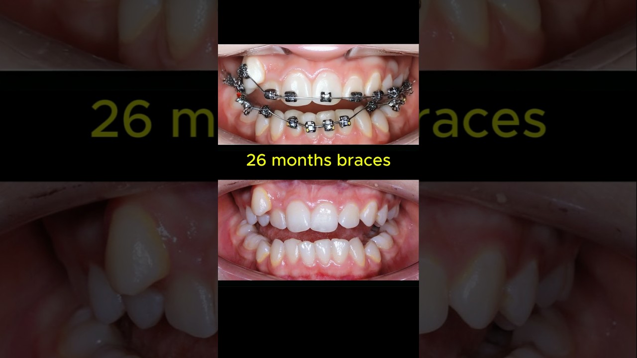 Braces journey. 26 months to complete #braces #dentist #orthodontist #teeth