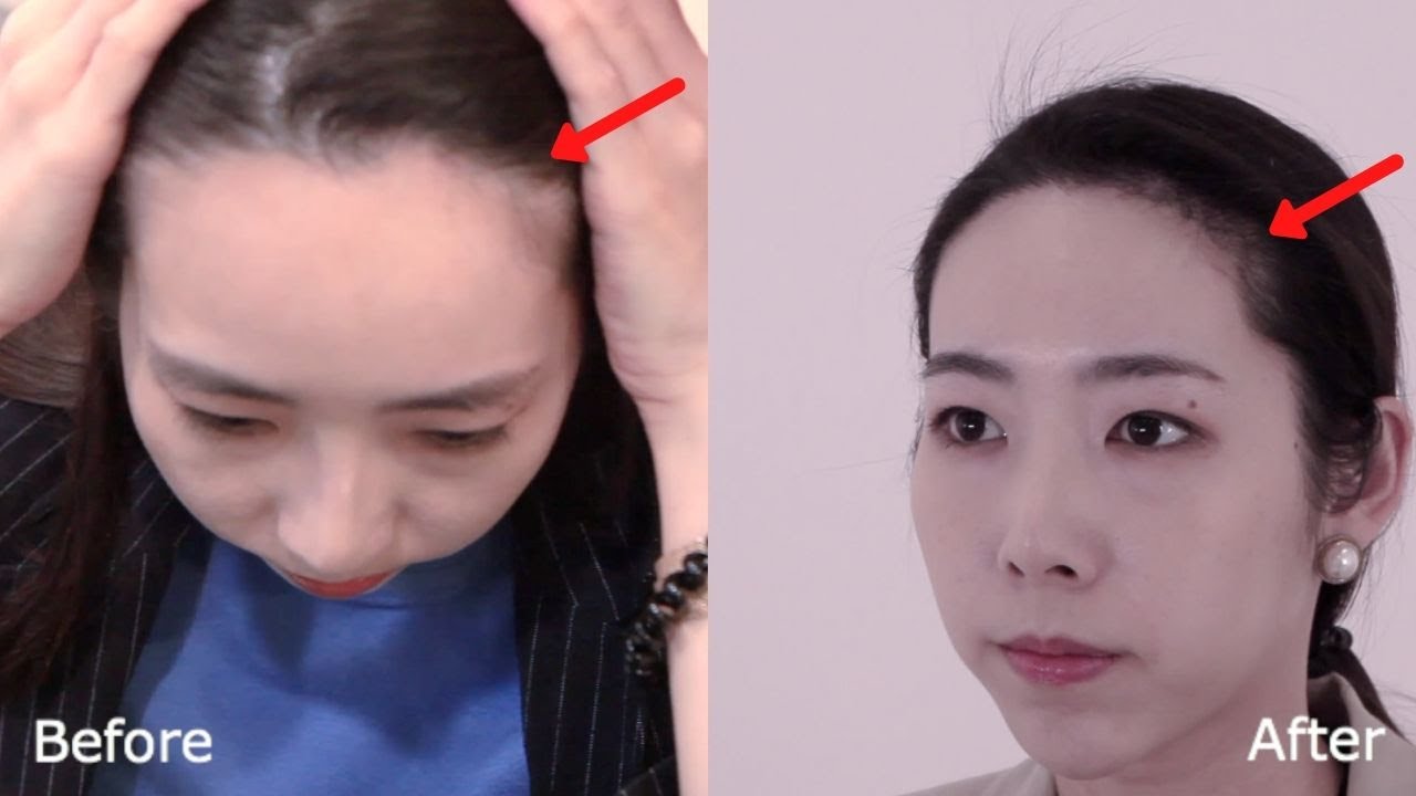 Hair Transplant in Korea - 4 Month Update | Seoul Guide Medical