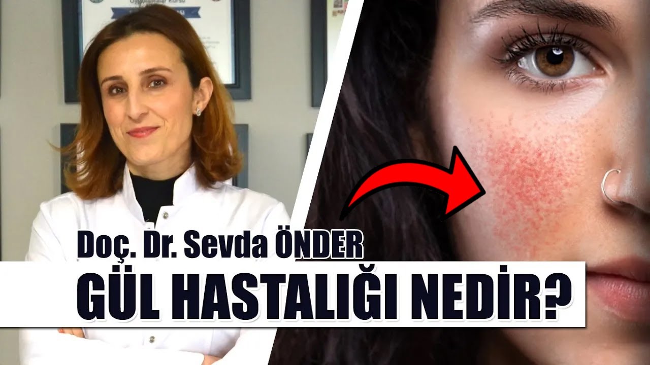 Yüz Kızarıklığı ve Gül Hastalığı: Sebepleri ve Çözümleri Gül Hastalığı Kalıcı mı? Tedavisi Nedir?