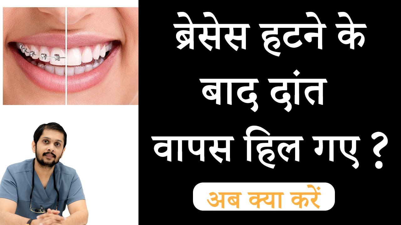 Relapse after braces | ब्रेसेस हटने के बाद दांत हिलने लगे | Best braces treatment in Indore