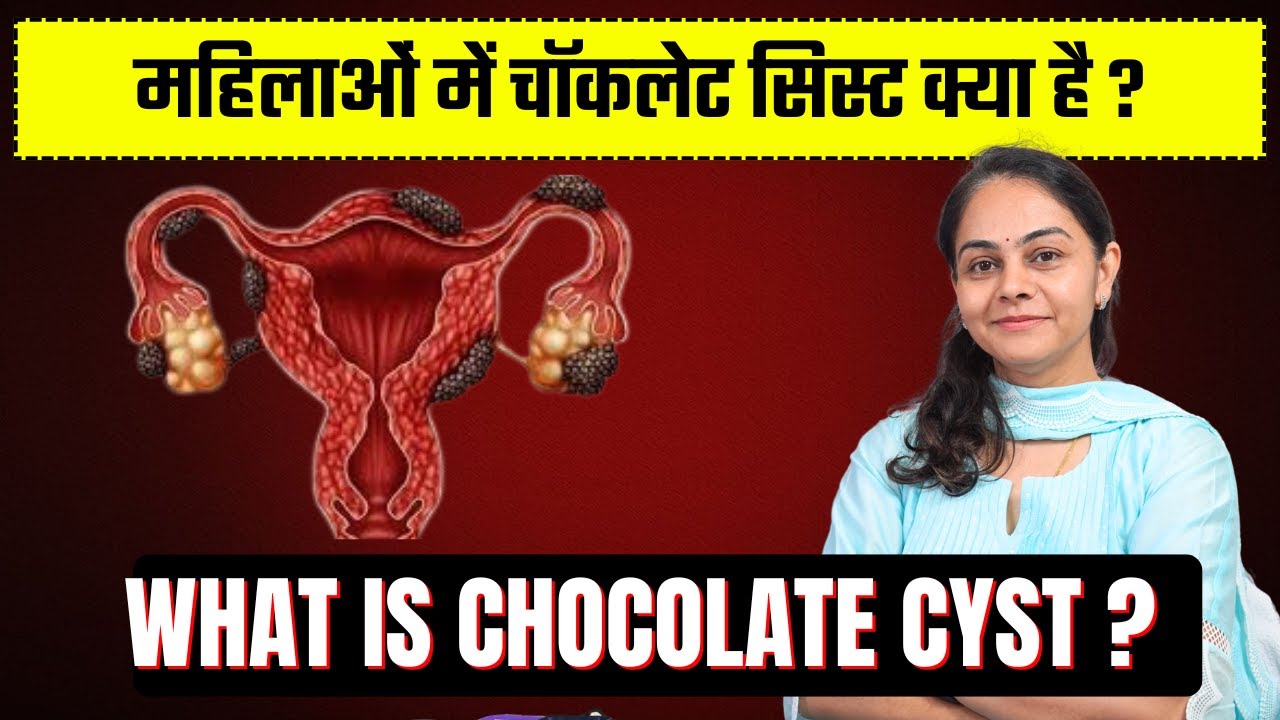 चॉकलेट सिस्ट क्या होती है और इसके कारण लक्षण व इलाज | Chocolate Cyst Causes and Symptoms