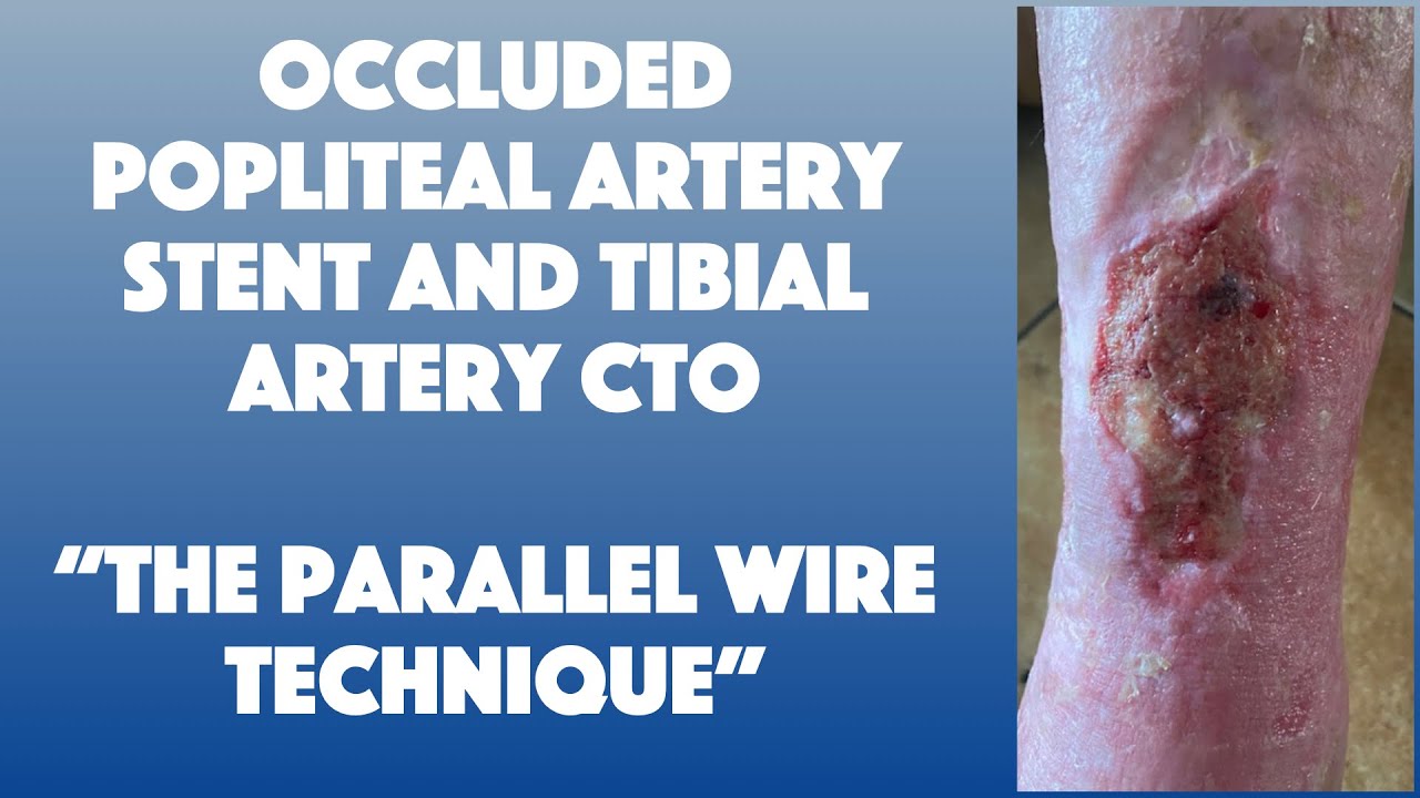 Occluded Popliteal Artery Stent and Tibial Artery CTO. 