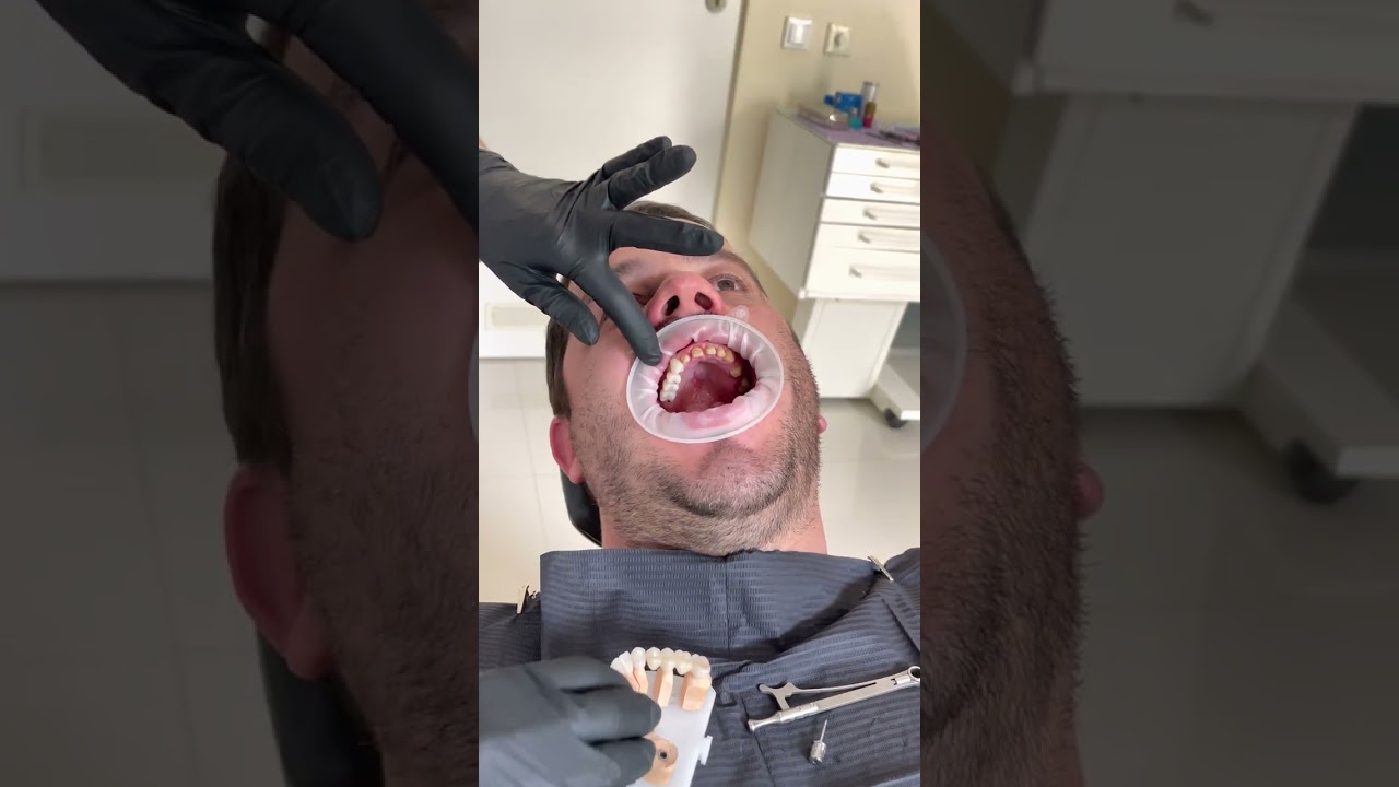 Refacerea danturii maxilare cu implanturi si coroane din zirconiu