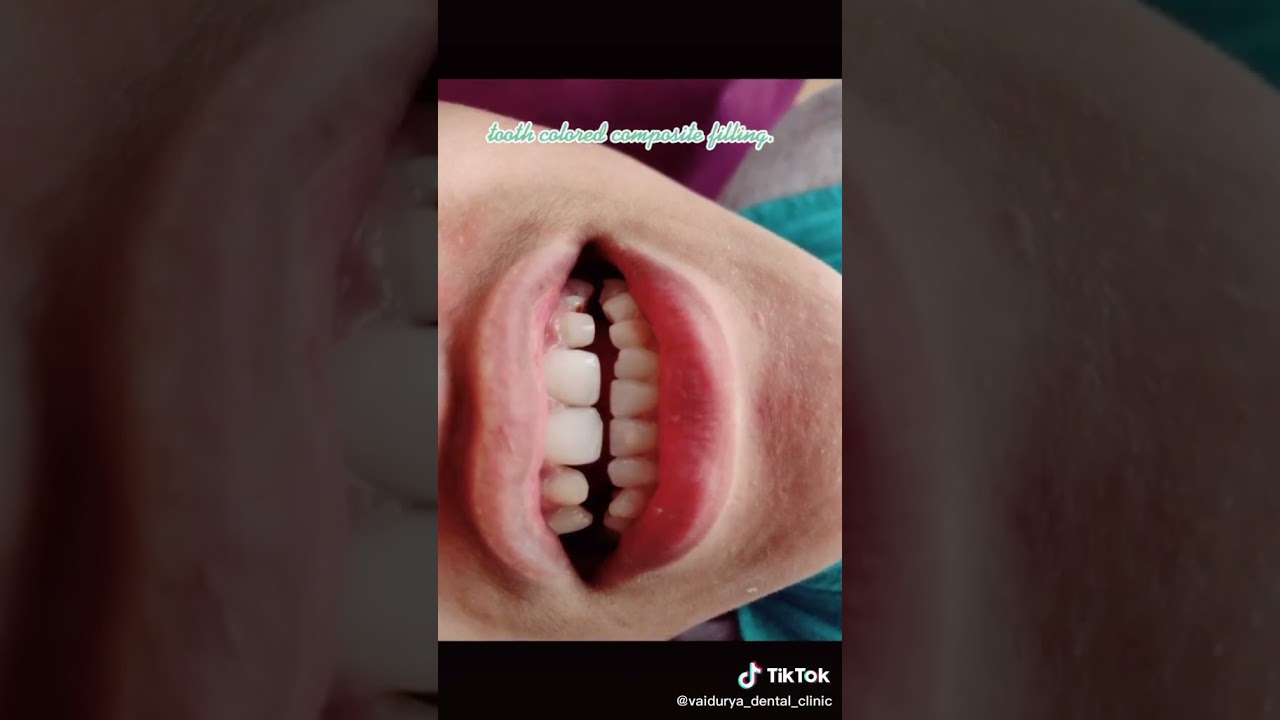 Teeth color composite filling #teethfilling #teethhealth