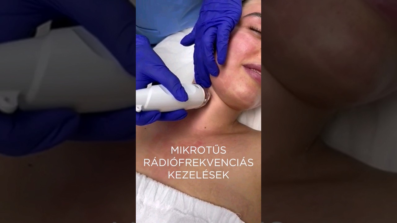 Mik a mikrotűs rádiófrekvenciás kezelések előnyei és kiknek ajánljuk?