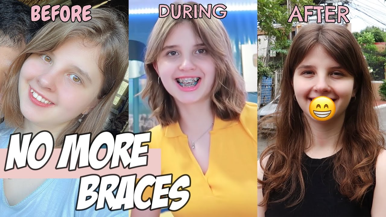 Getting My Braces Off After 16 Months!
