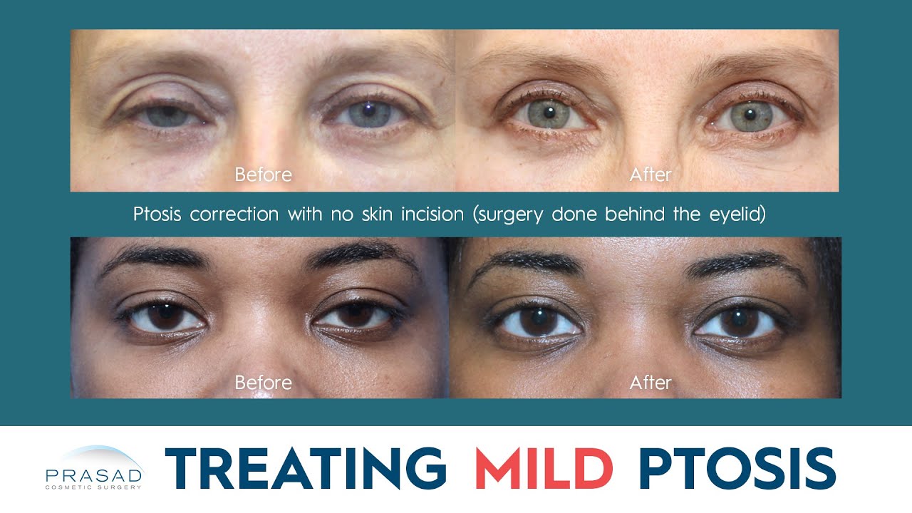 How Mild Ptosis is Treated