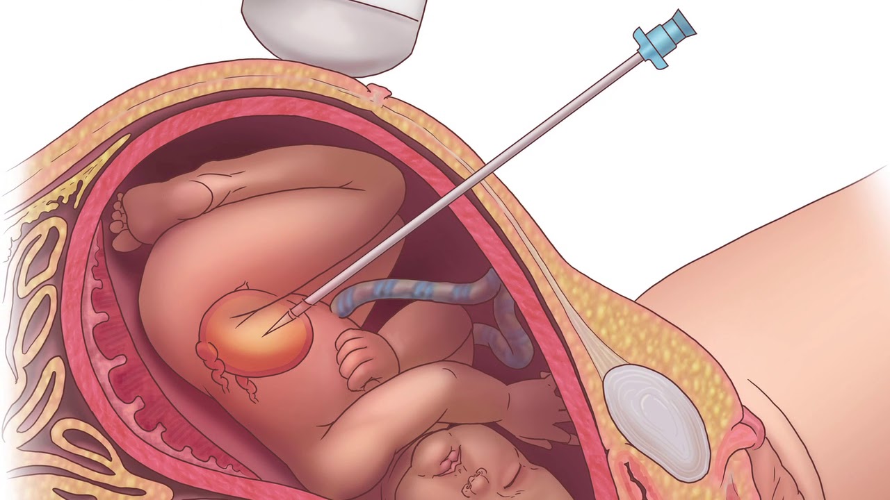 Texas Children&rsquo;s Fetal Center&reg; Lower Urinary Tract Obstruction (LUTO) Educational
