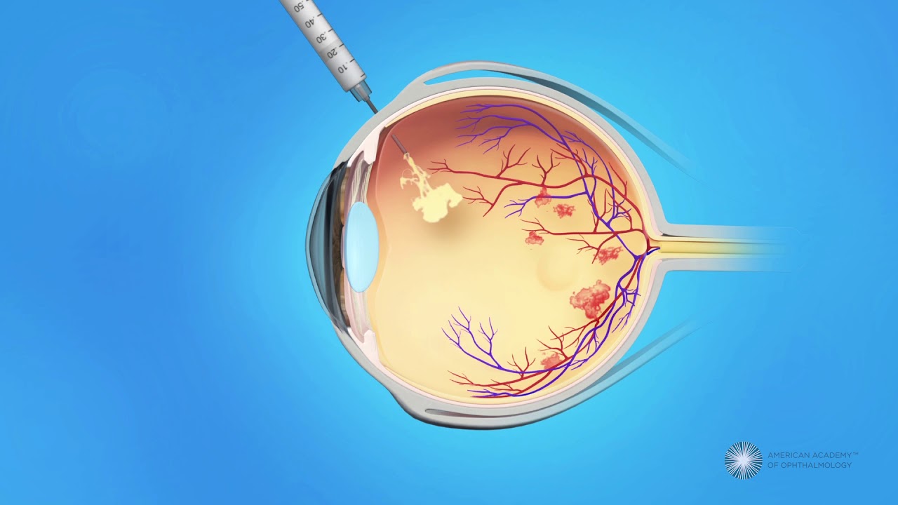 Eye Injections for Central Retinal Vein Occlusion (CRVO)
