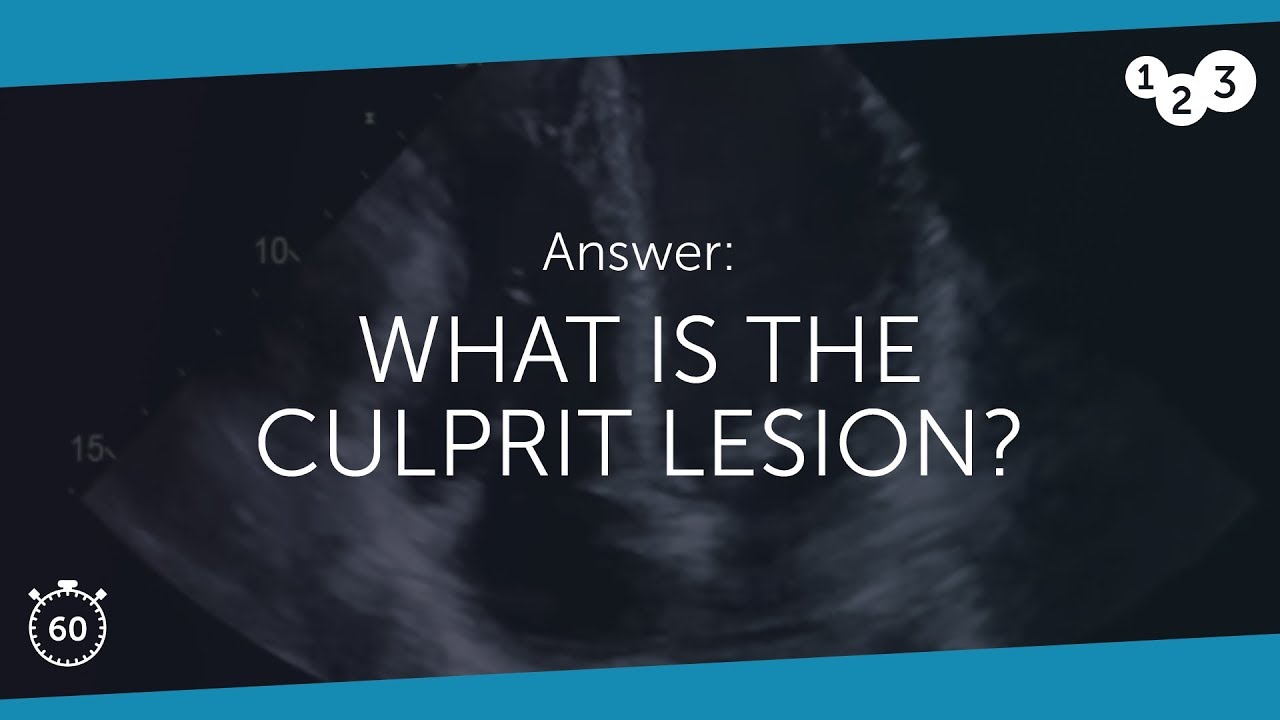 60 Seconds of Echo Teaching Answer: What is the culprit lesion?